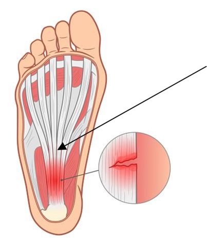 Three Exercises for Plantar Fasciitis