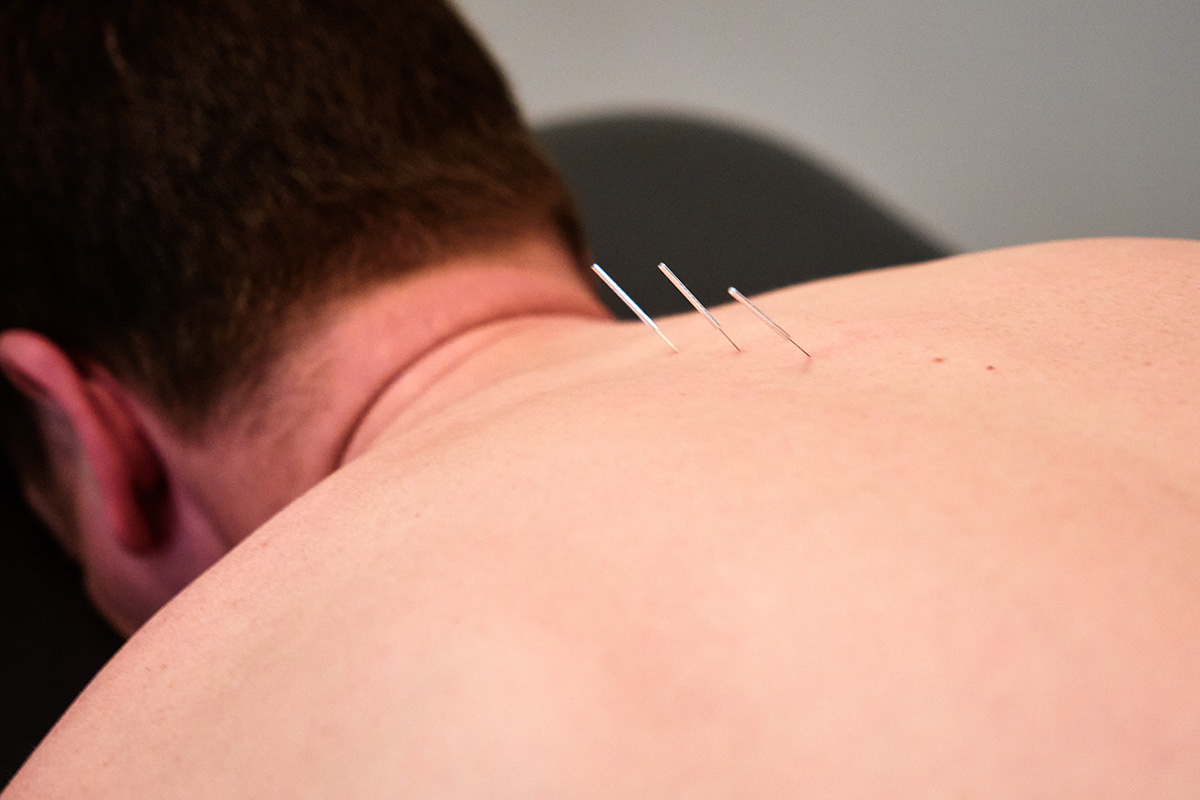StriveBC-acupuncture-2